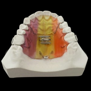 深圳义齿CAD/CAM技术和3D打印技术、透明牙套保持器